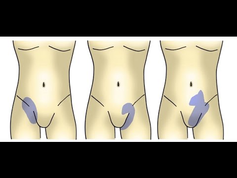 Descubre efectivos ejercicios para lesi&oacute;n de ingle y acelera tu recuperaci&oacute;n
