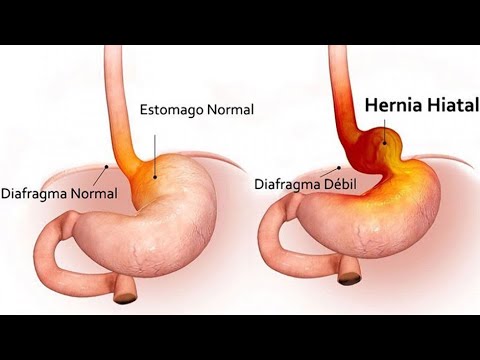Hernia de hiato: &iquest;C&oacute;mo identificar el bulto en el estern&oacute;n?