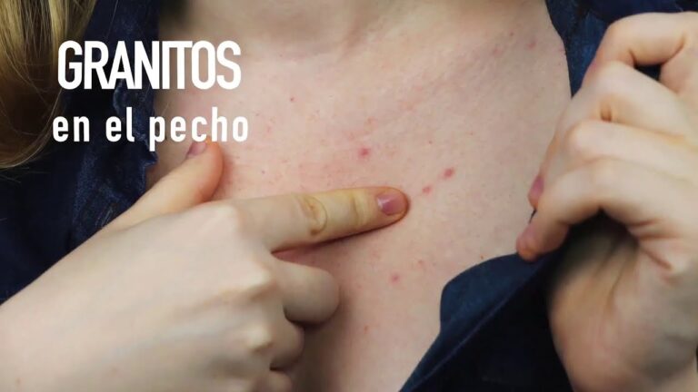 Desp&iacute;dete de los granos del pecho r&aacute;pidamente: &iexcl;Trucos efectivos!