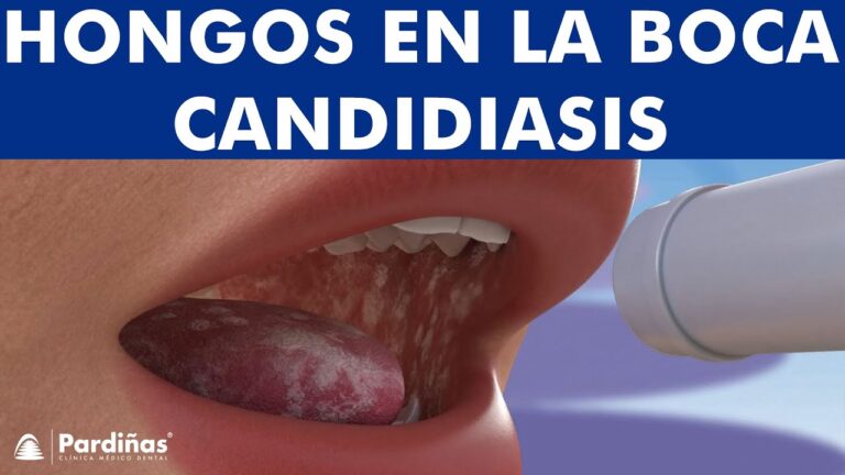 Candidiasis oral: el peligro oculto en tu cerveza