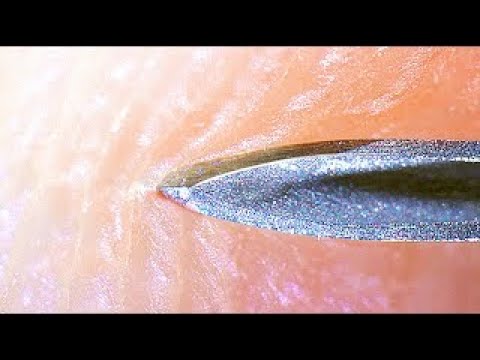 Nueva t&eacute;cnica revolucionaria &iexcl;sin agujero de la piel!