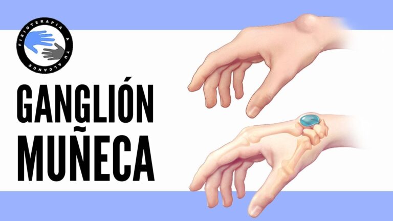 ¡Descubre el tiempo de recuperación por quiste sinovial en la muñeca!