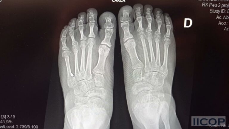 &iexcl;Descubre c&oacute;mo prevenir la luxaci&oacute;n en el pie y evitar lesiones!