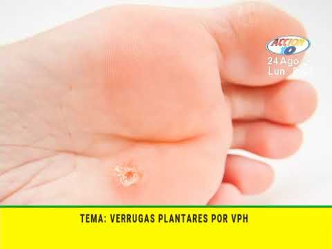 Alerta: Papiloma afecta dedos de los pies