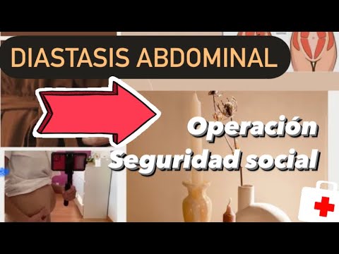 Diástasis abdominal: ¿La Seguridad Social lo cubre?
