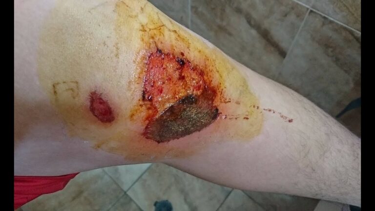 &iexcl;Prot&eacute;gete! C&oacute;mo evitar heridas por abrasi&oacute;n de asfalto