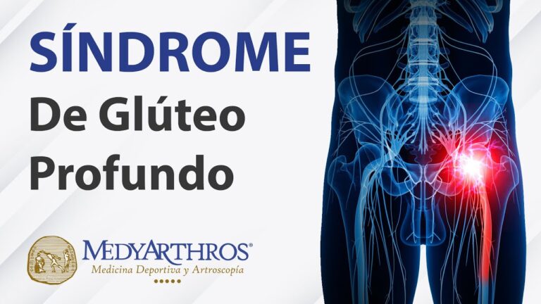 Descubre cómo aliviar el síndrome del glúteo profundo de forma efectiva
