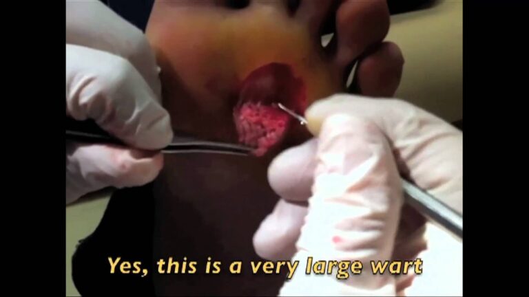 Descubre cómo curar el papiloma plantar de forma efectiva